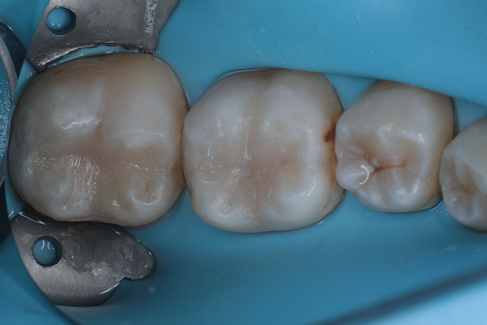 #18-19 after