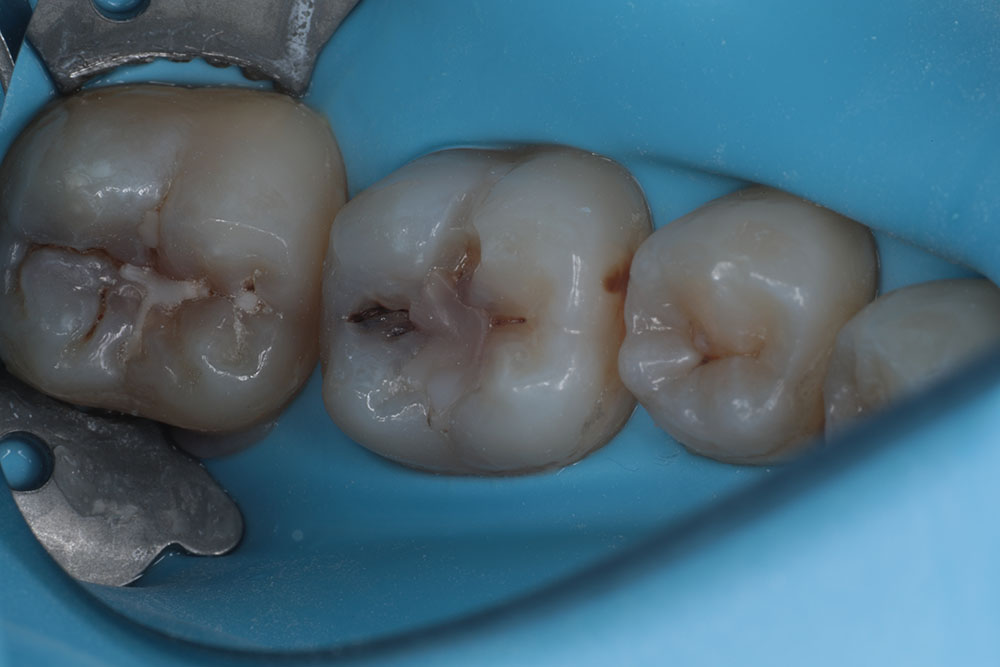 #18-19 before