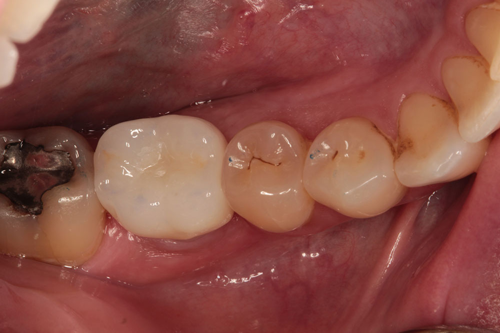 #30 implant after 1