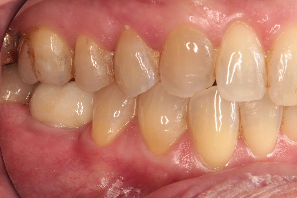 #30 implant after 2