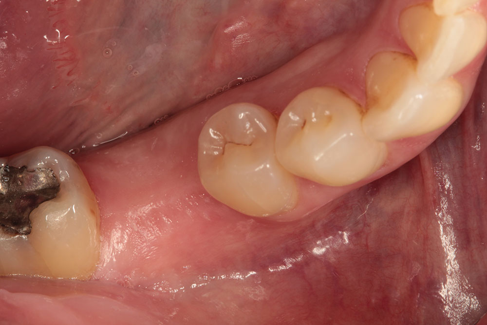 #30 implant before 1