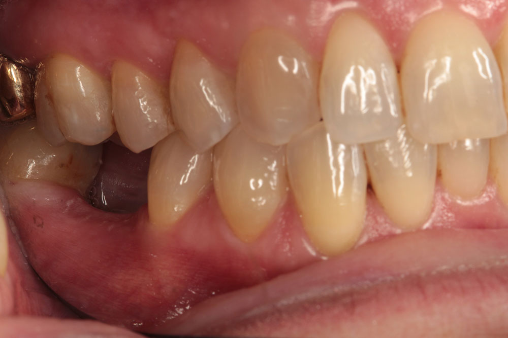#30 implant before 2