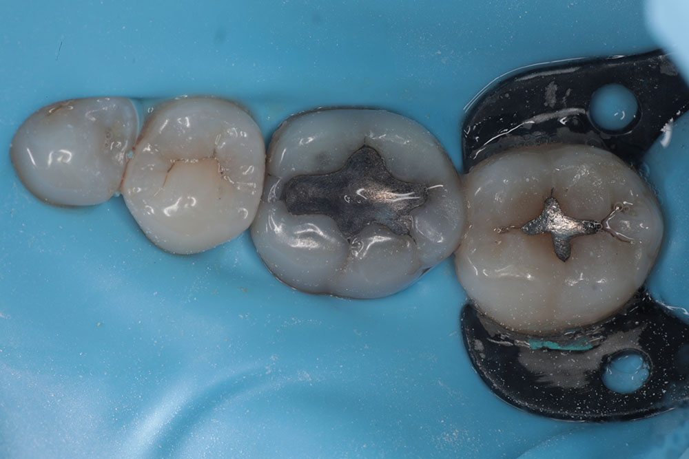 #30 onlay before