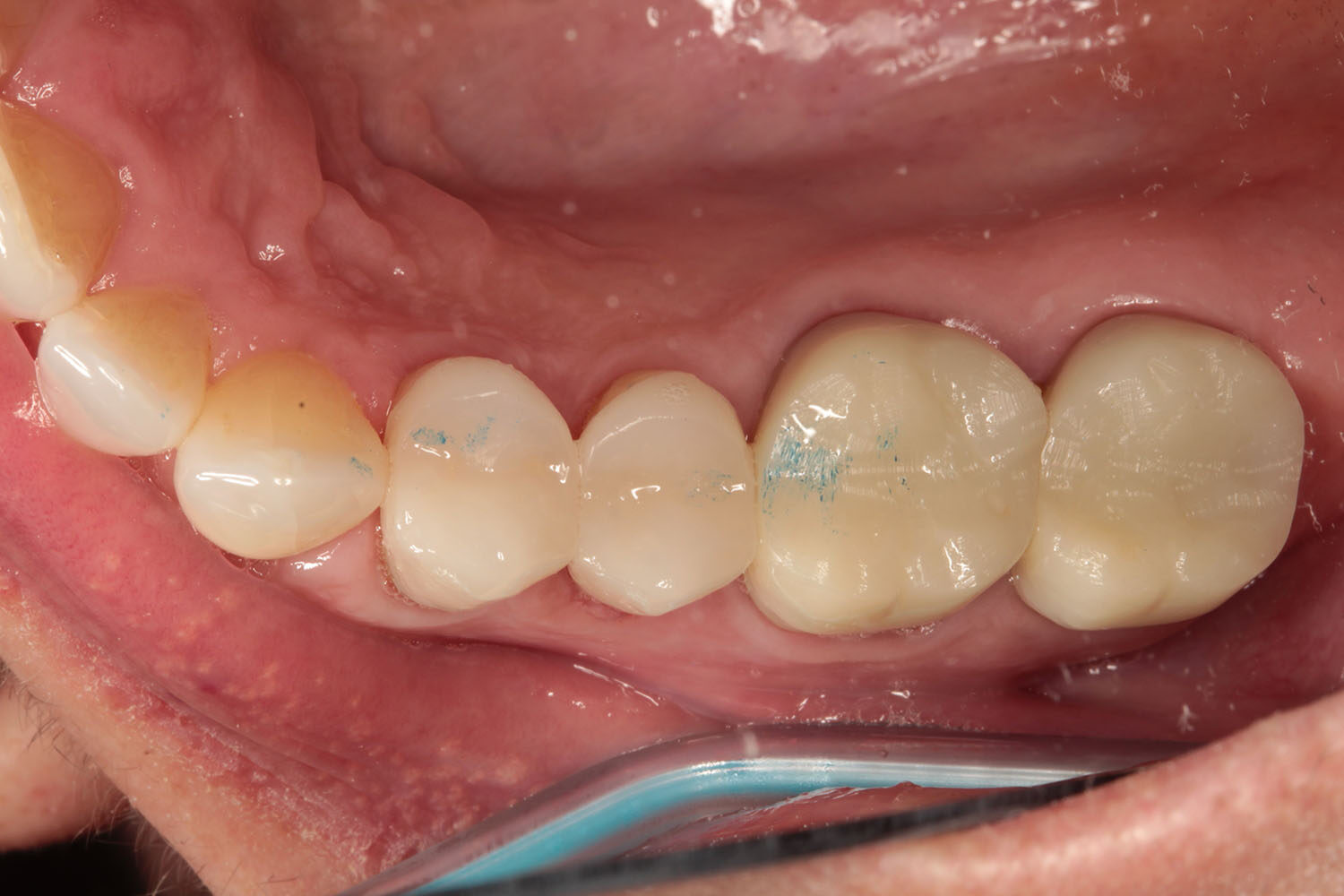 #4-5 veneers after