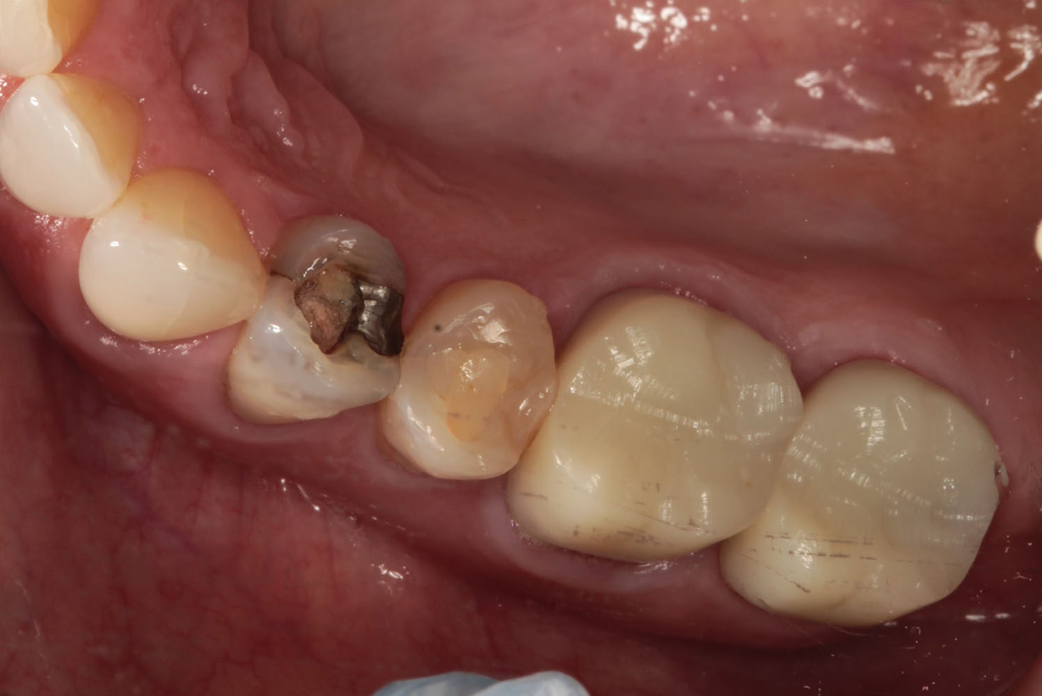 #4-5 veneers before