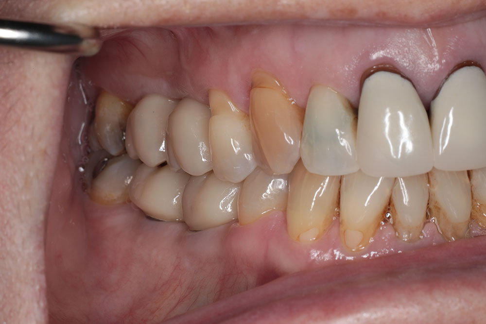 4 molars after