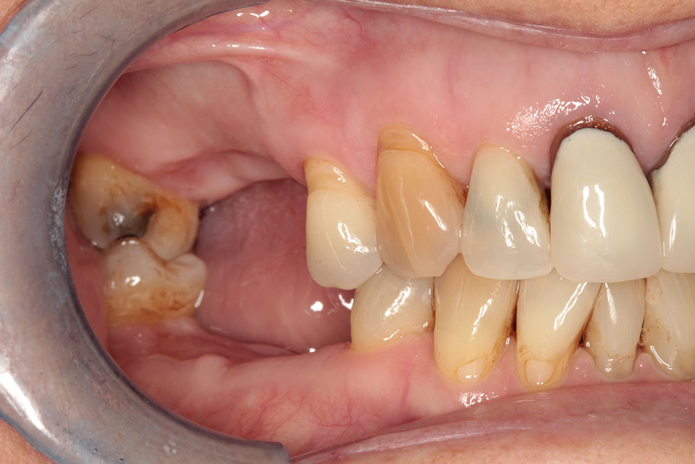 4 molars before