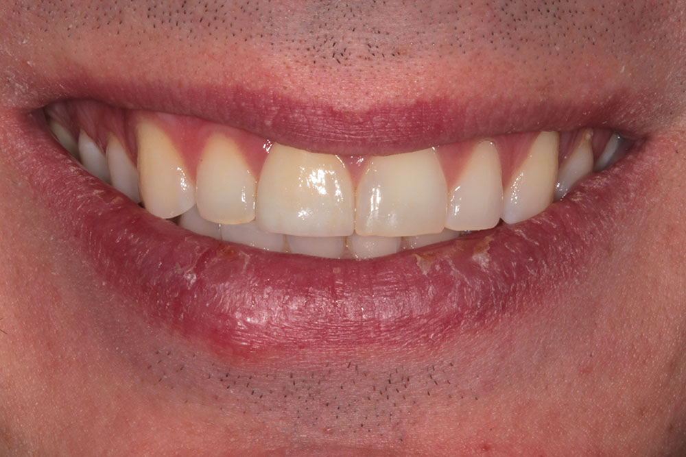 #8 veneer after