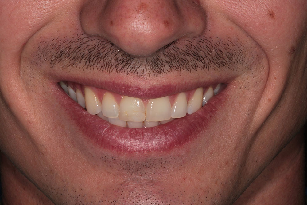 #8 veneer before