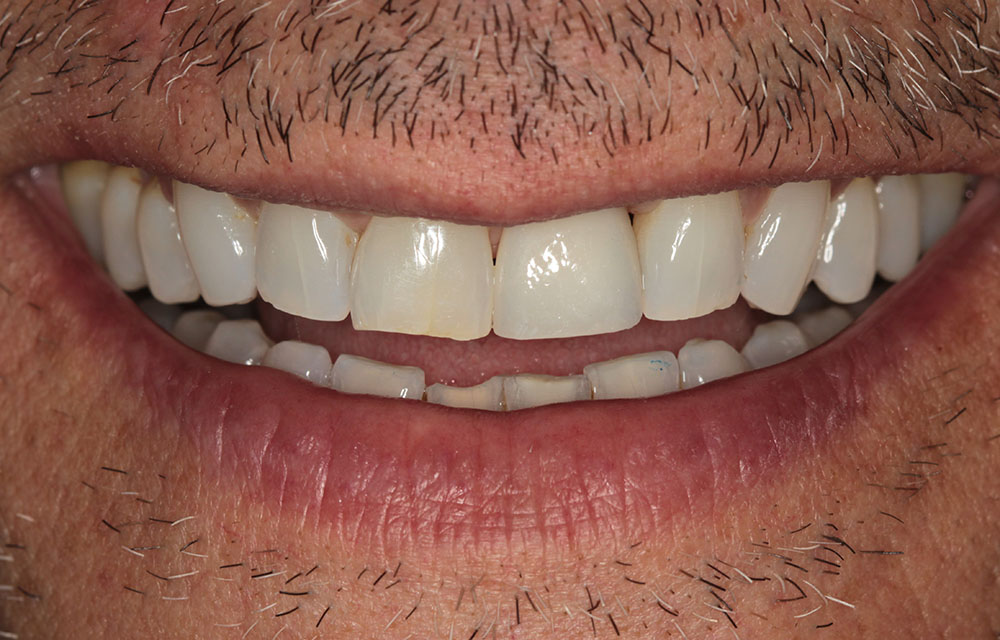 #9 implant after