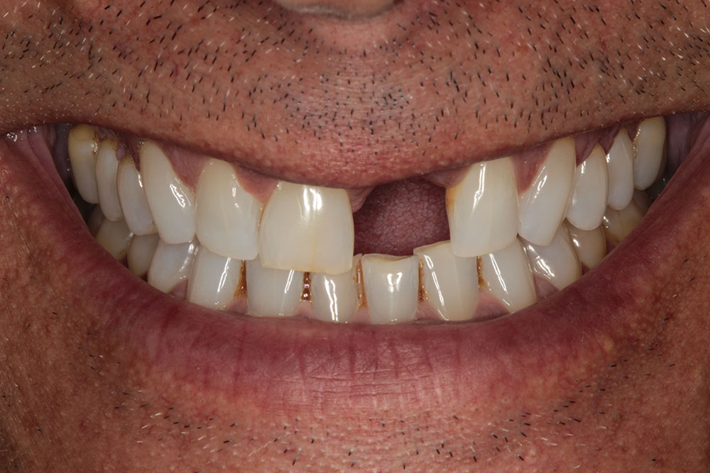 #9 implant before