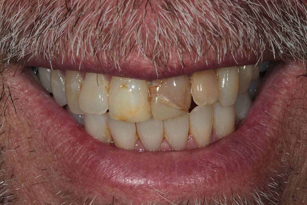 BG before
