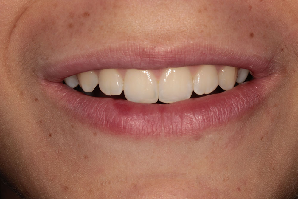 Chipped Teeth after