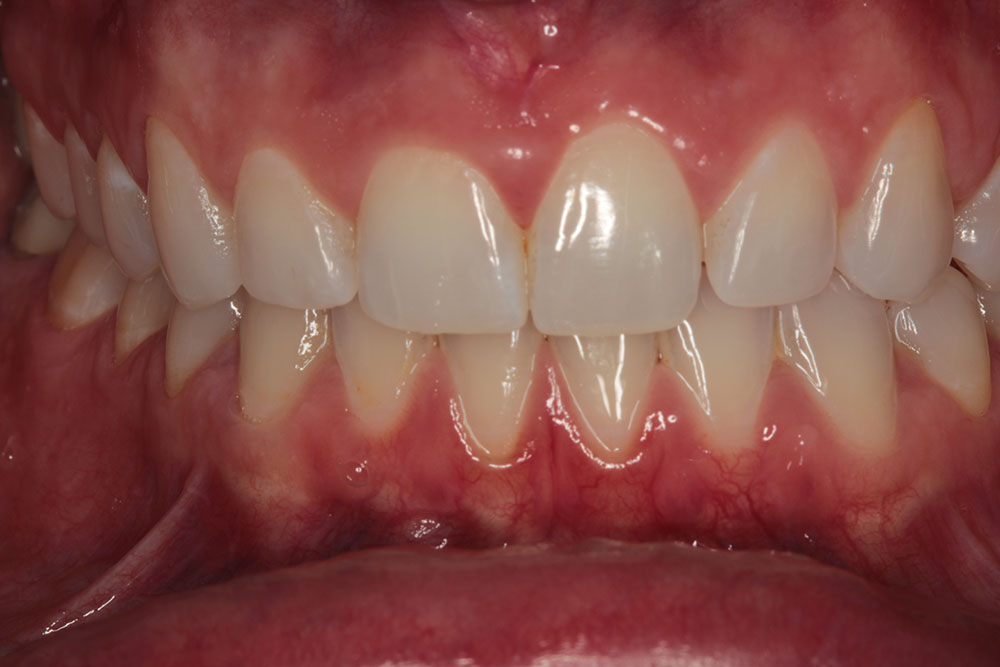 Gum reshapping before