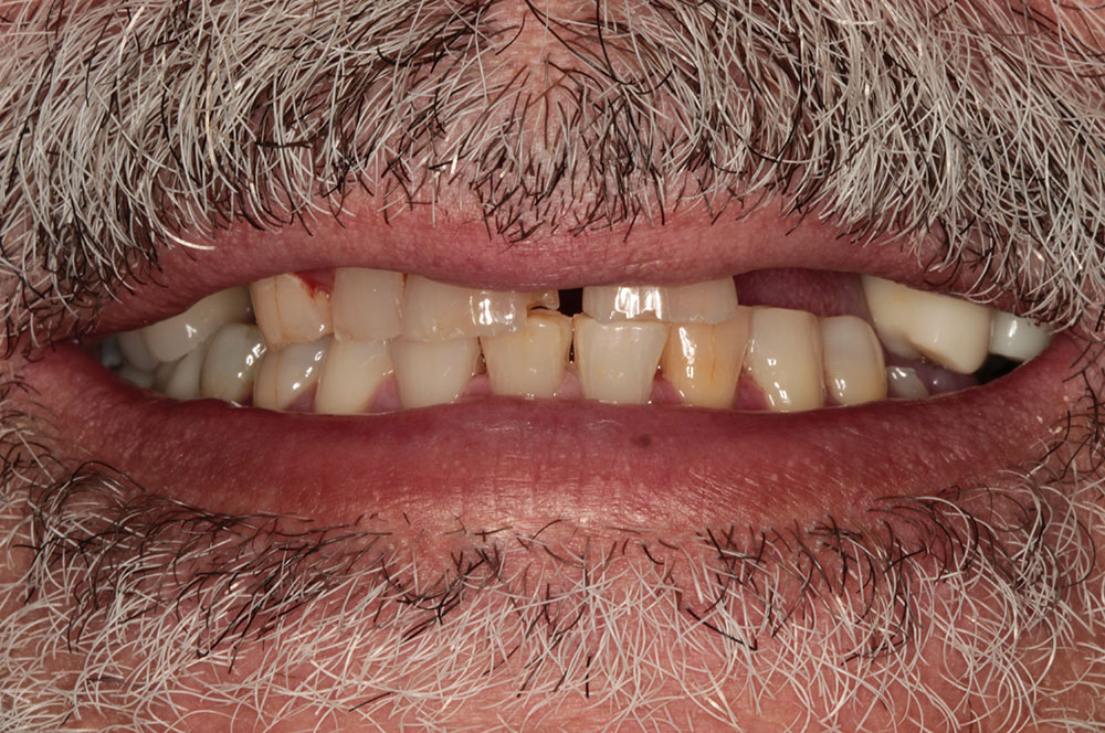 HG before