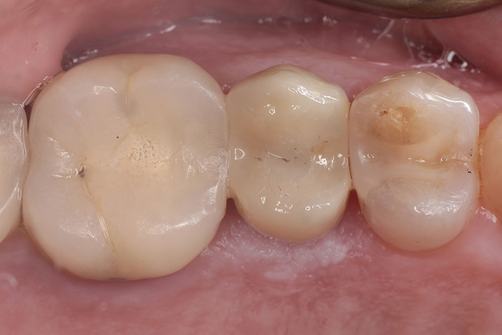 Implant #13 after