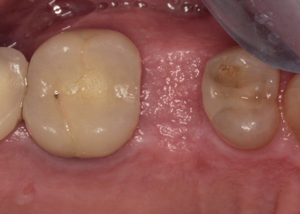 Implant #13 before