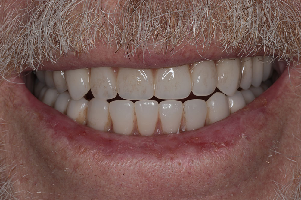 JR after