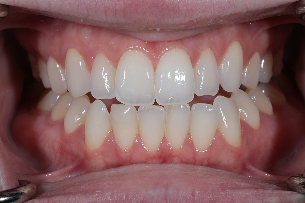 bleaching and #26 filling after