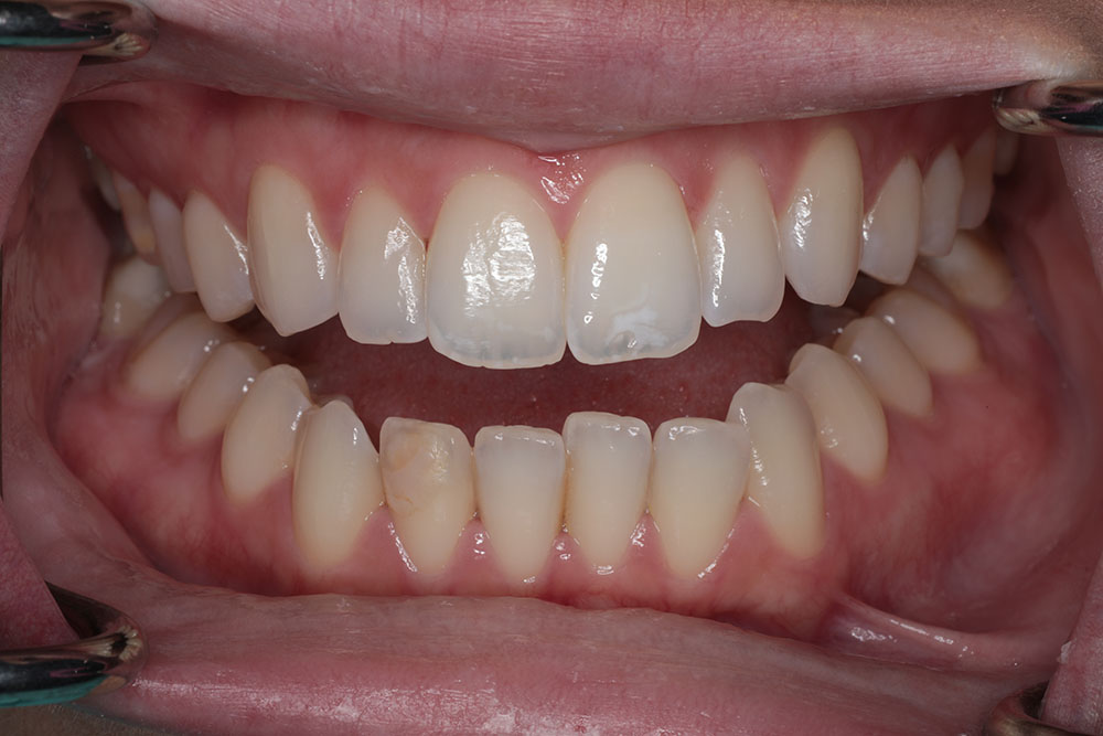 bleaching and #26 filling before