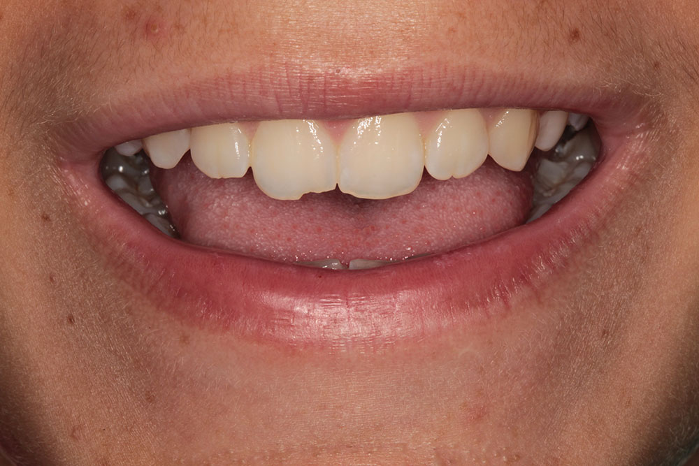 chipped teeth before