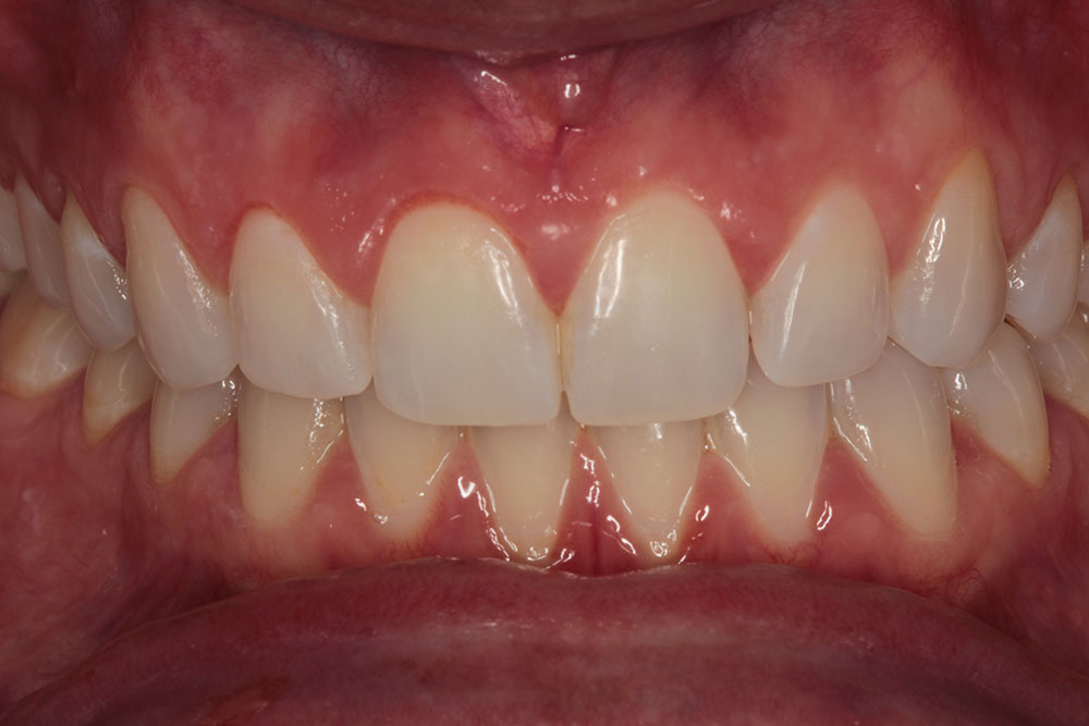 gum reshaping after