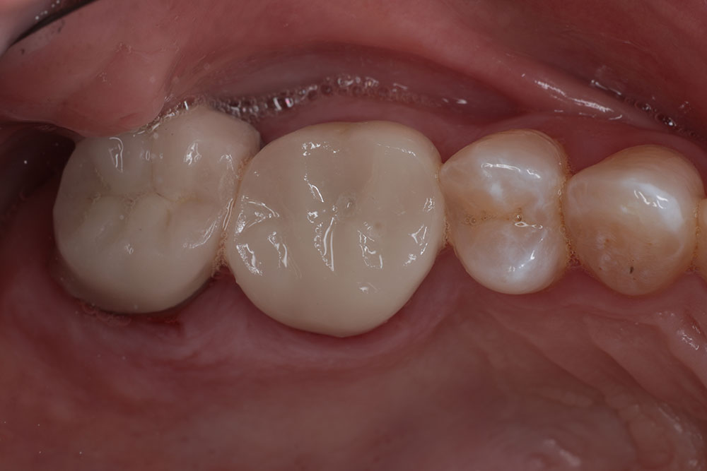 hopeless tooth after 1