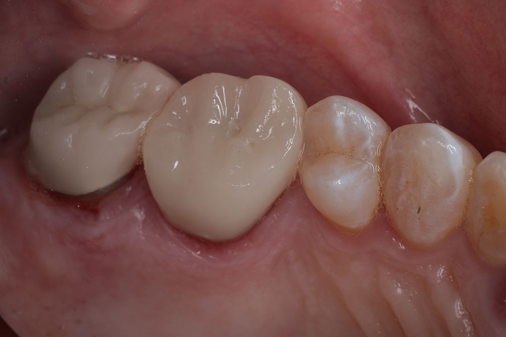 hopeless tooth after 2