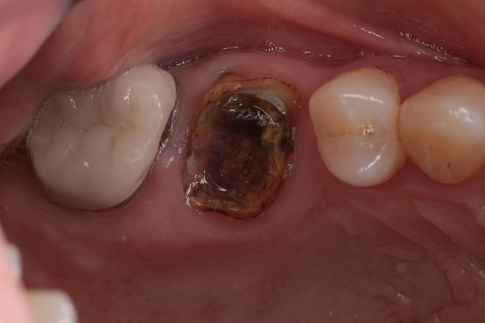 hopeless tooth before 1