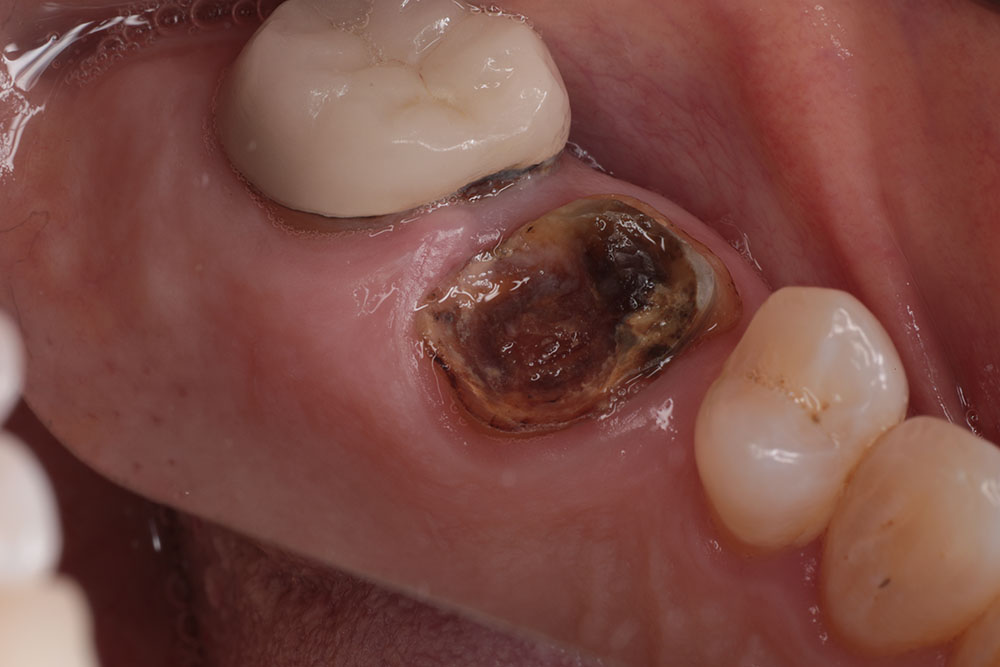 hopeless tooth before 2