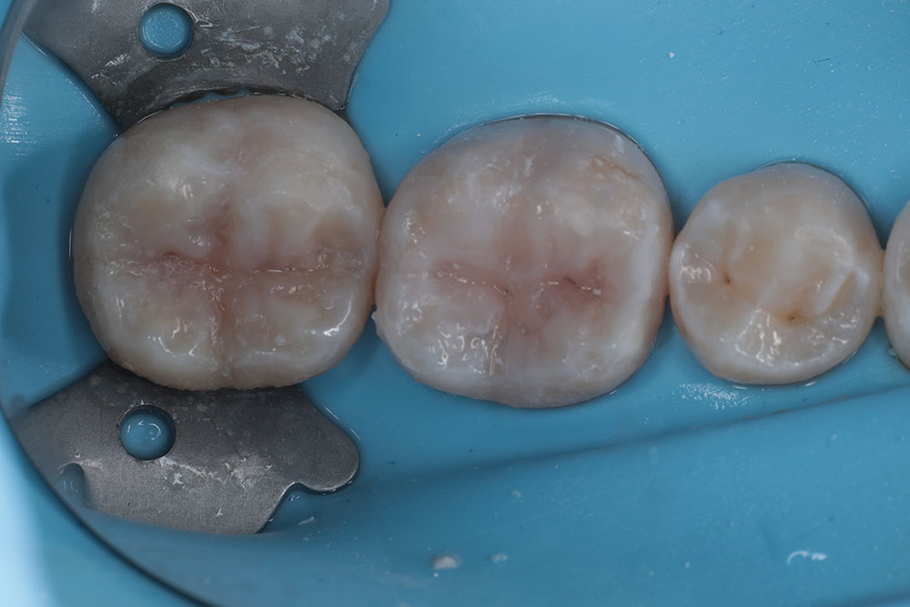 molar cavities after