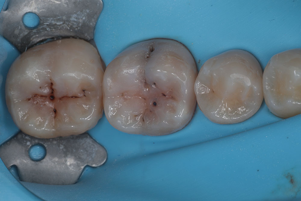 molar cavities before