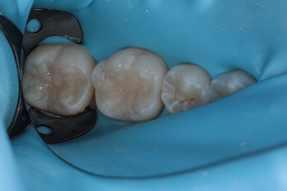 molar occlusals after