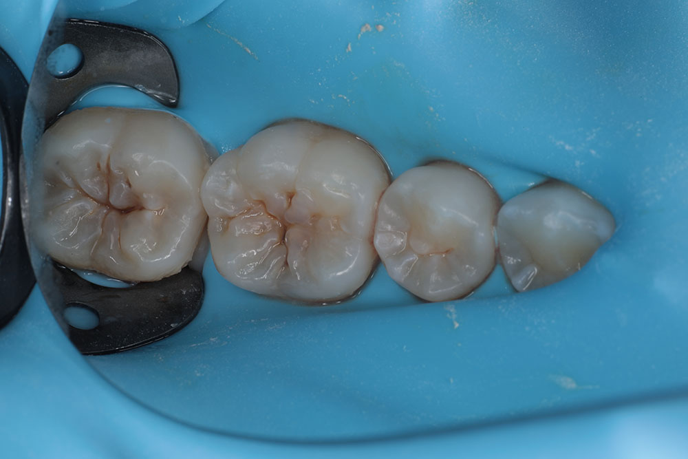 molar occlusals before