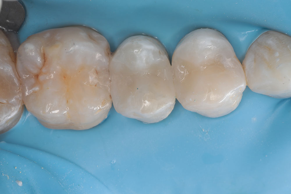 premolar fillings after