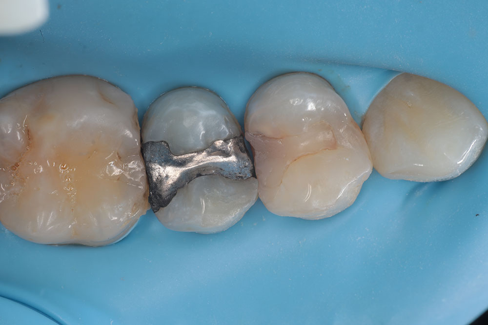 premolar fillings before